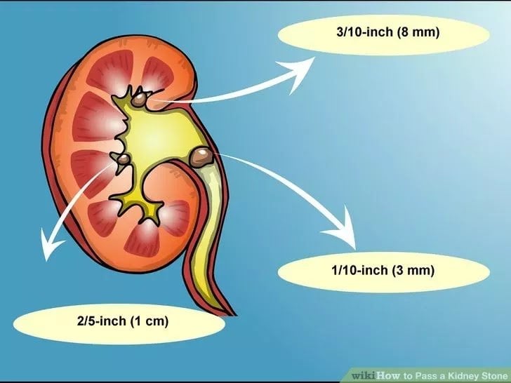 Kidney Stone Removal Complications