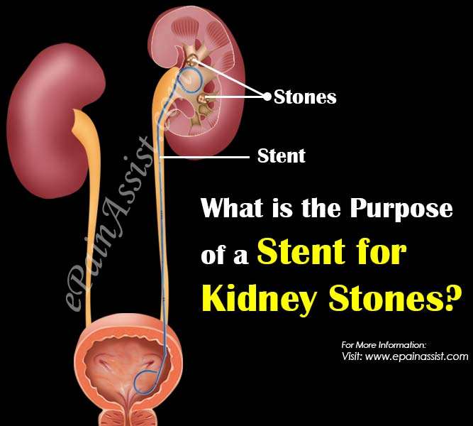 Kidney Stone Removal Stent Pain