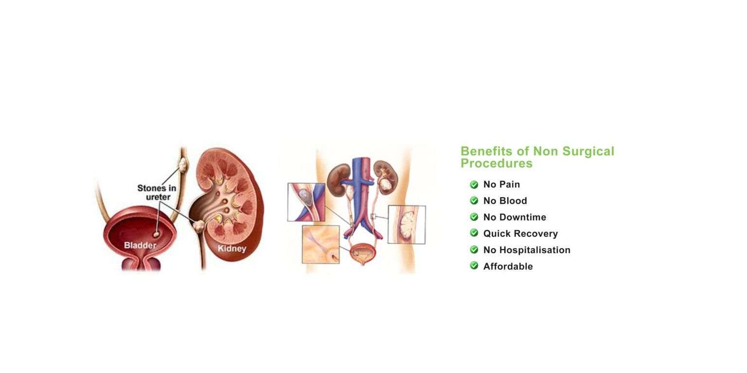 Kidney Stone Removal Surgery Blood In Urine