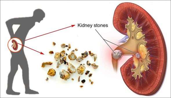 Kidney Stone Removal Surgery Outpatient