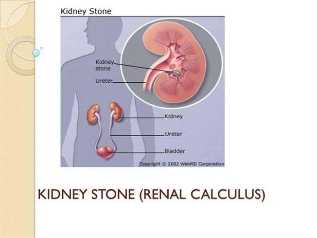 KIDNEY STONE (RENAL CALCULUS)