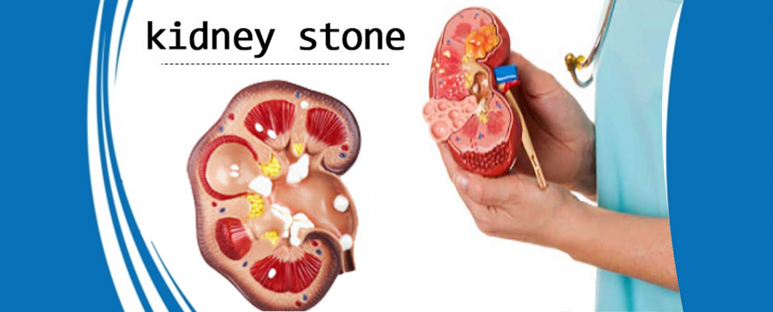 Kidney Stone Symptoms And Right Treatment