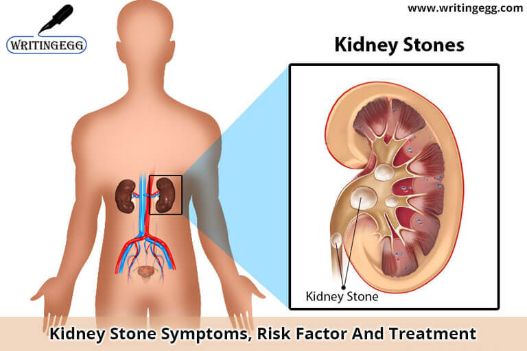 Kidney Stone Symptoms, Risk Factor And Treatment