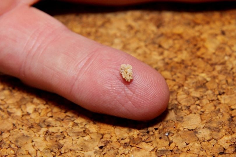 Kidney Stone Symptoms, Treatment, and Prevention