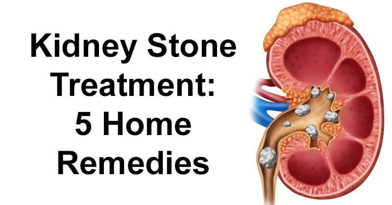 Kidney Stone Treatment: 5 Home Remedies