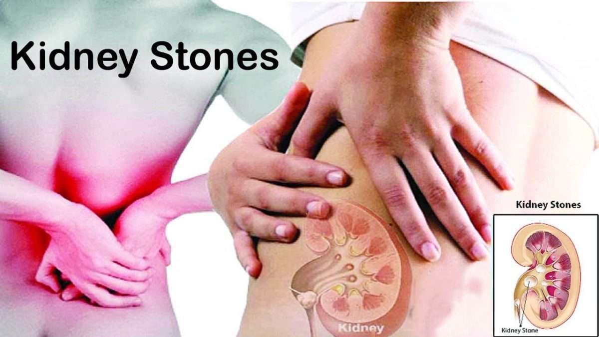 Kidney Stones â Prevention, Home Remedies, Herbal Treatment &  Post ...