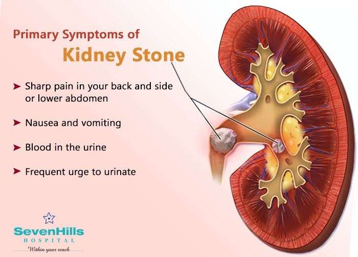 Kidney Stones Blood But No Pain