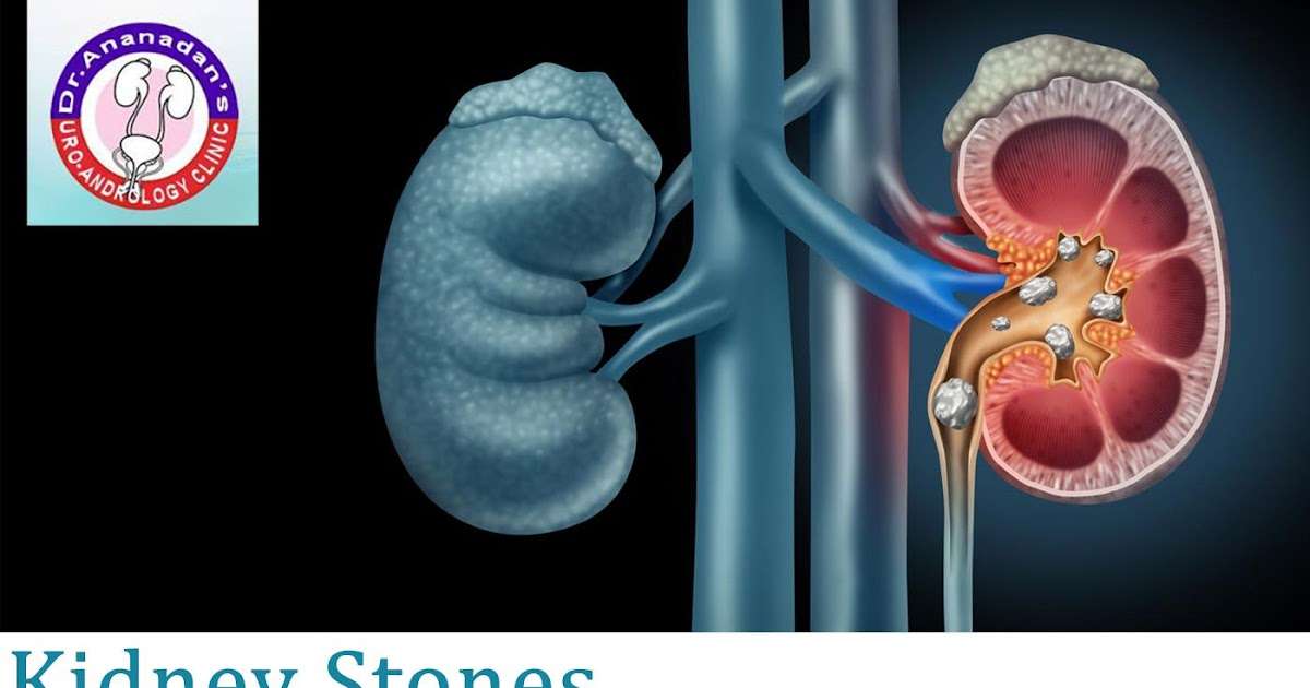 Kidney Stones Cause Urge To Urinate