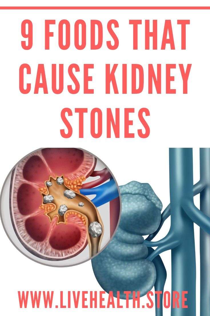 Kidney Stones Causes Vitamin