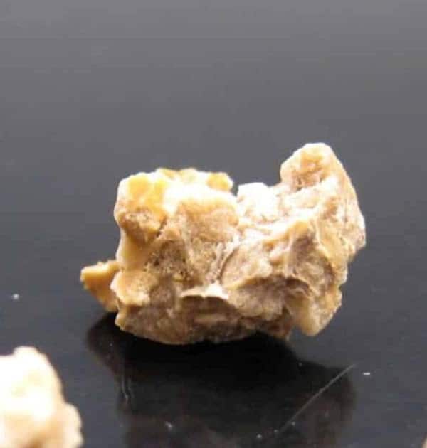 Kidney Stones From Energy Drink Photos