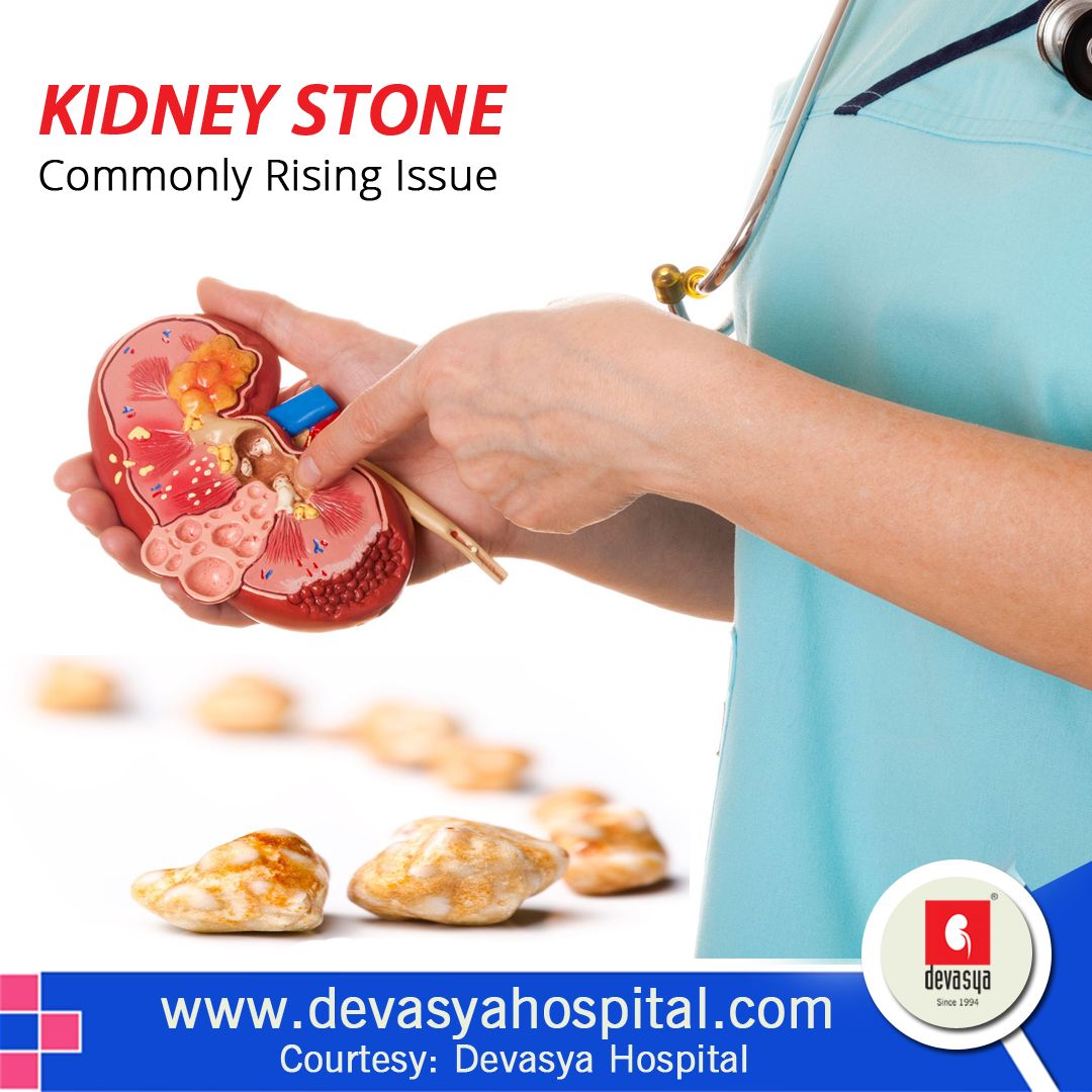 Kidney Stones Gout Connection