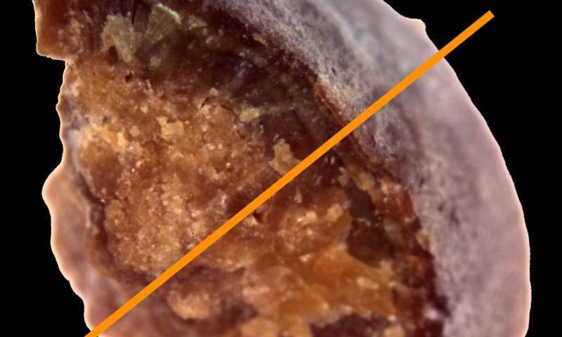 Kidney stones have distinct geological histories, study finds