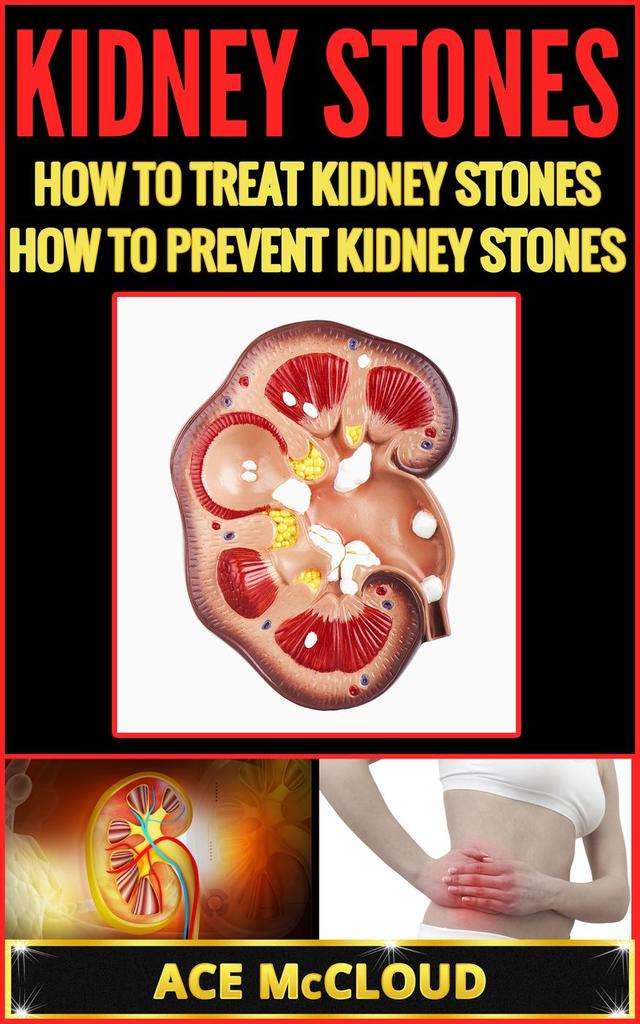 Kidney Stones: How To Treat Kidney Stones: How To Prevent Kidney Stones ...