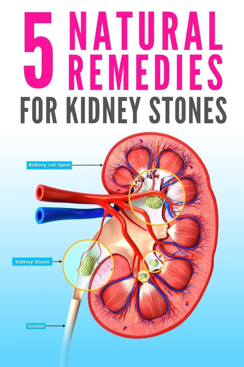 Kidney Stones In The Emergency Department