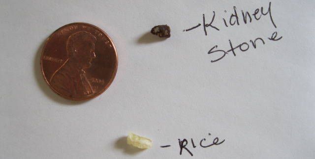 Kidney stones may look small, but you definitely don
