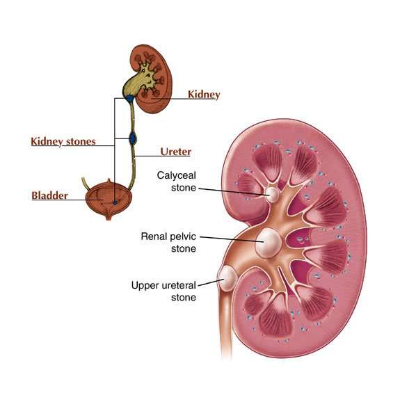 Kidney Stones: Pain, Symptoms and Treatment