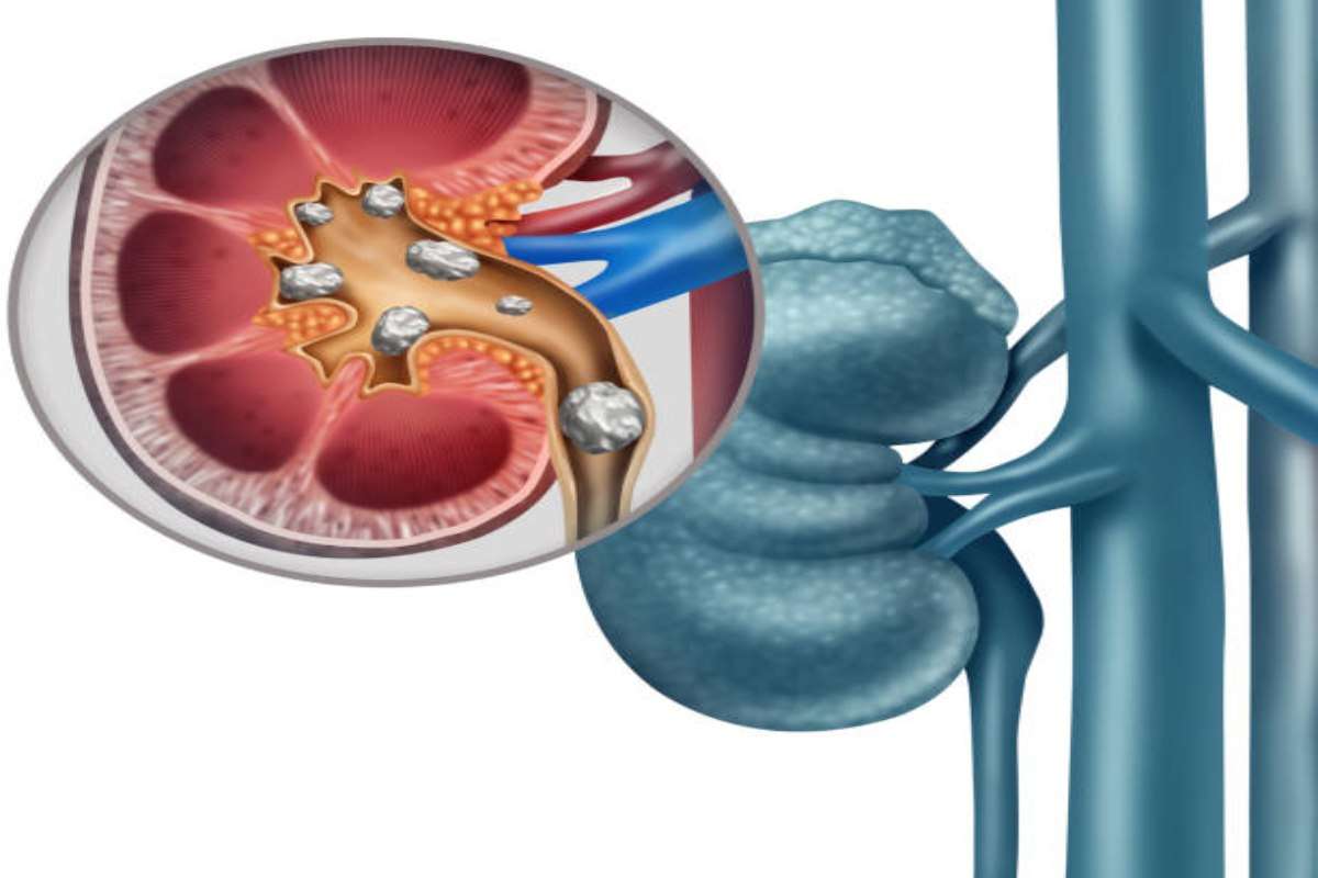 Kidney Stones: Remedies To Cure The Pain Post