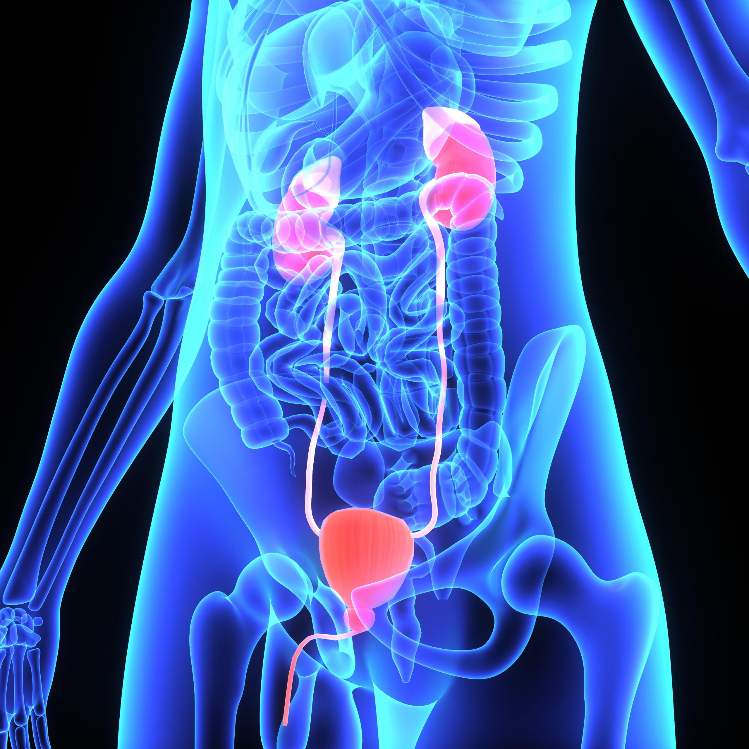 Kidney Stones (renal Colic)
