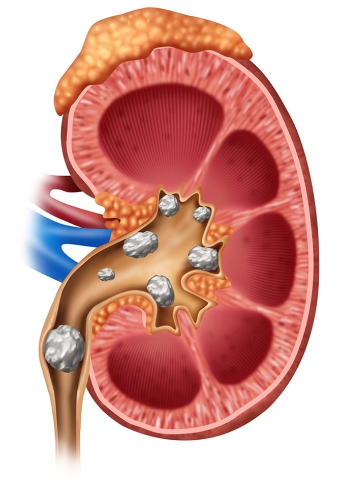 Kidney stones (renal lithiasis) Causes, Symptoms and ...