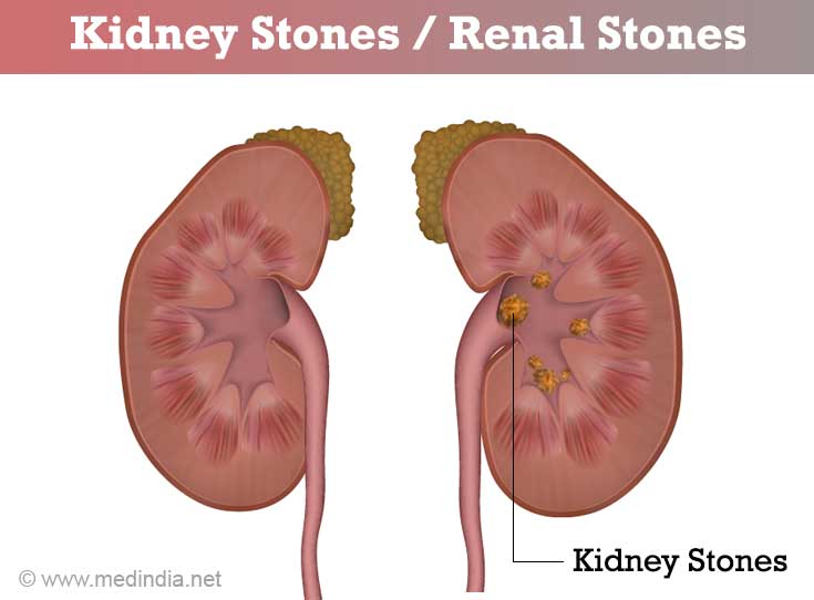 Kidney Stones / Renal Stones