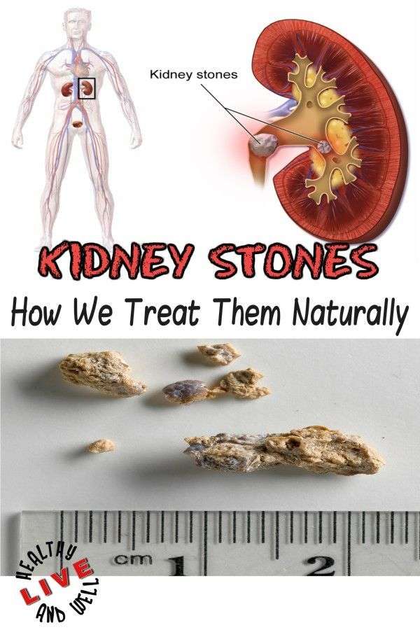 Kidney Stones? See how to treat them naturally!