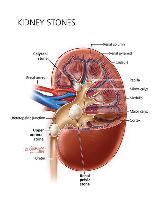 Kidney Stones: Symptoms, Diagnosis &  Treatment