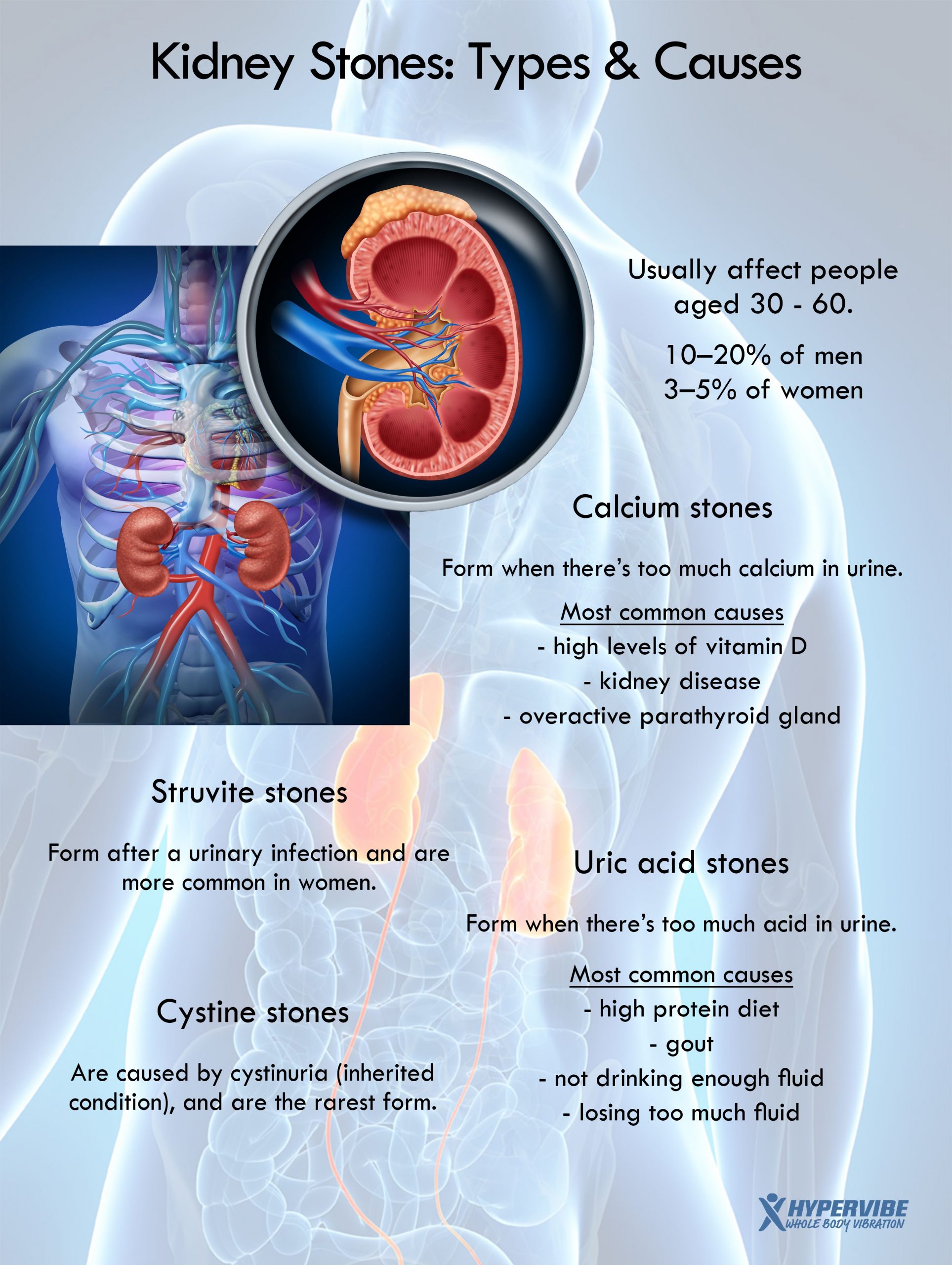 Kidney Stones Symptoms Weight Loss