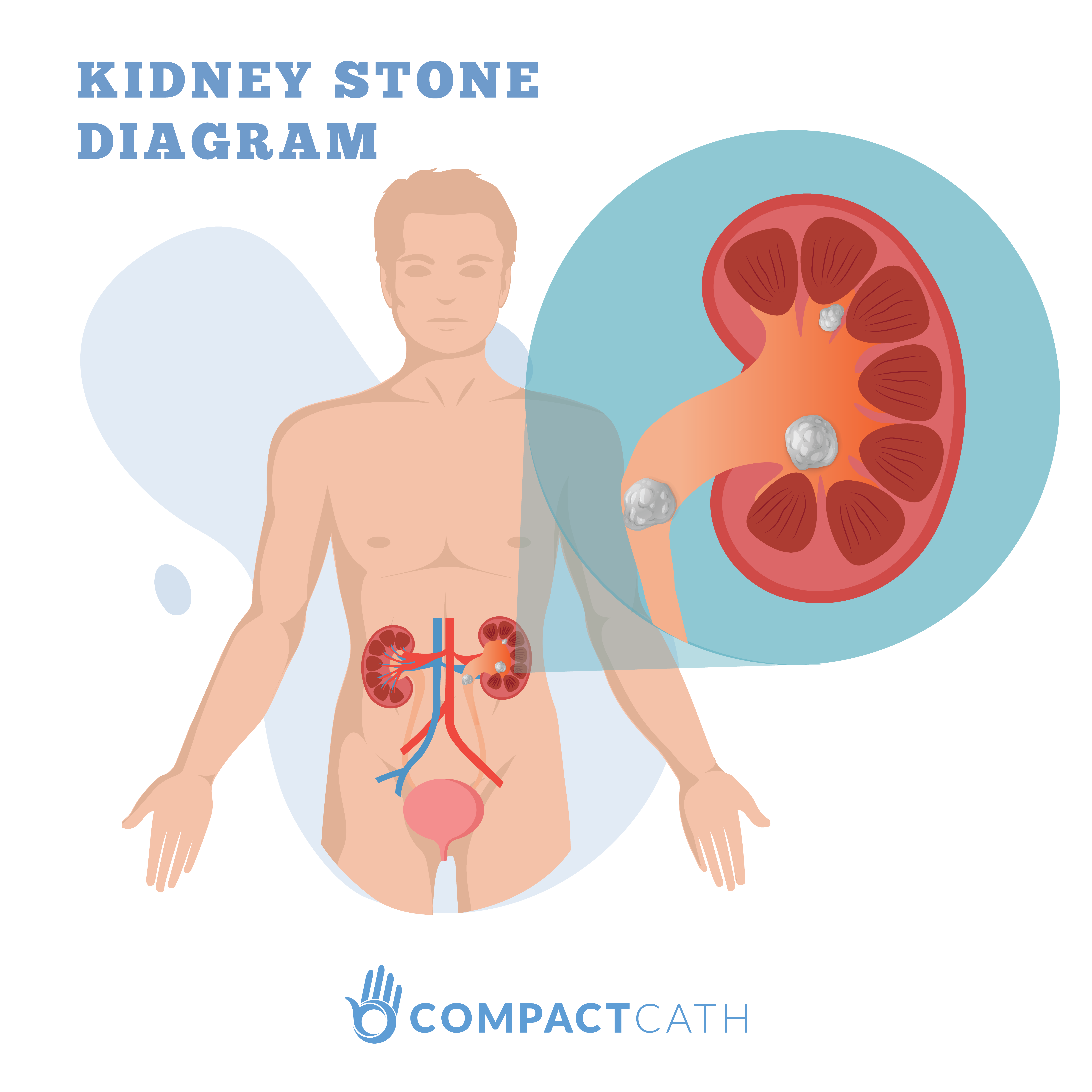 Kidney Stones: The Ultimate Beginners Guide