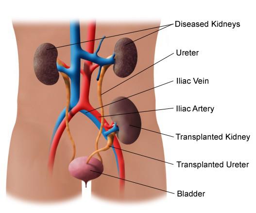 Kidney Transplant Treats Kidney Failure