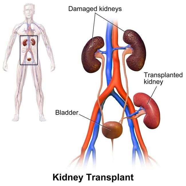 Kidney Transplant : Types, Procedure, Risk &  Cost » How To ...