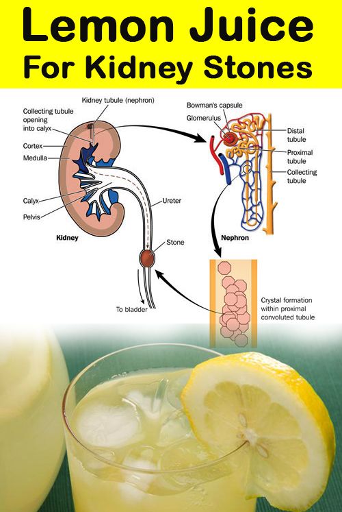 Lemon Juice for Kidney Stones Treatment