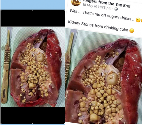 Supersaturation: The Cause Of Kidney Stones