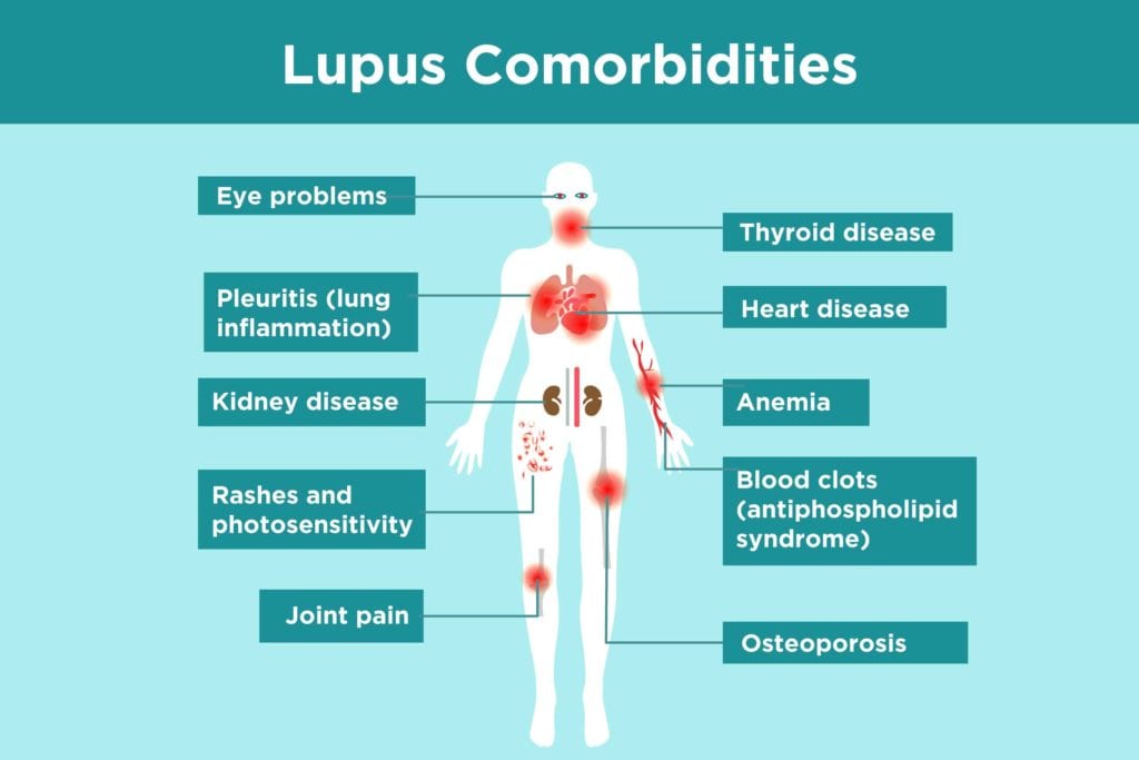 Lupus Complications: What Lupus Patients Need to Know