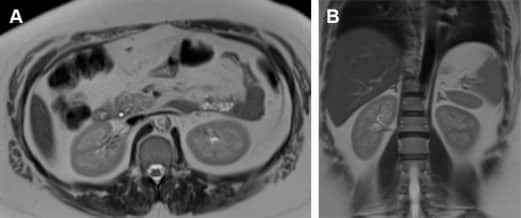 MR Imaging Evaluation of the Kidneys in Patients with Reduced Kidney ...