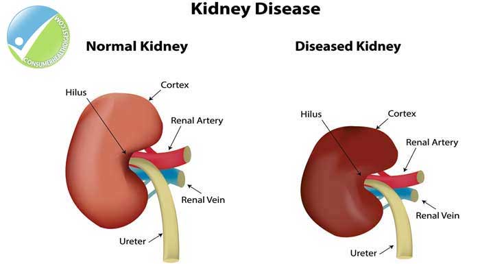 National Kidney Month: Campaign to Prevent Kidney Disease