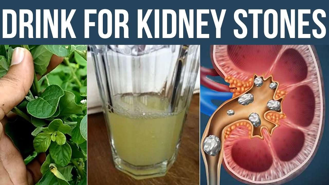 Natural Drink For Kidney Stones