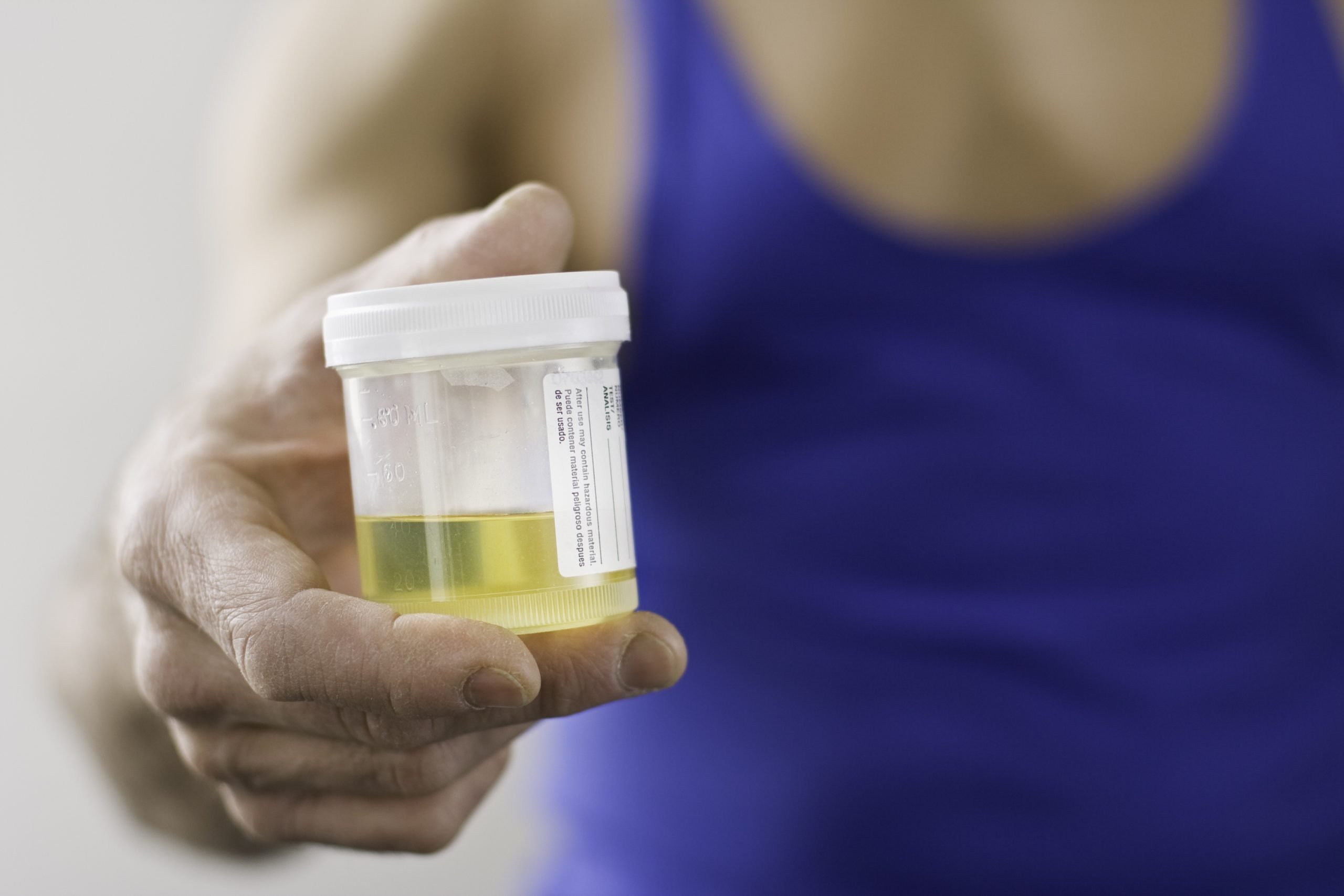 New Urine Test Capable of Detecting Disease that Causes ...