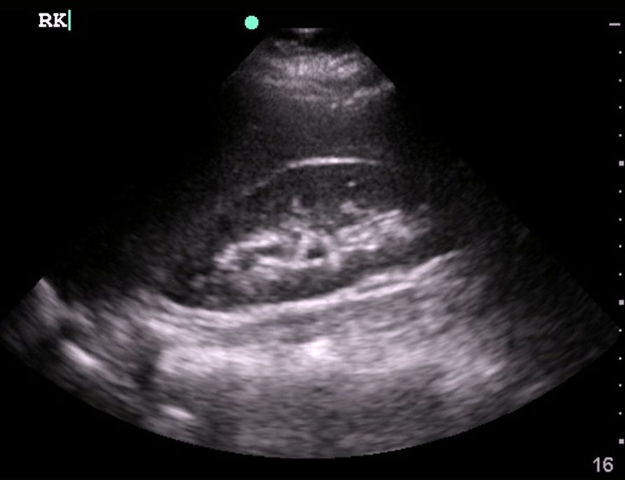 Normal Abnormal Kidney Ultrasound Images