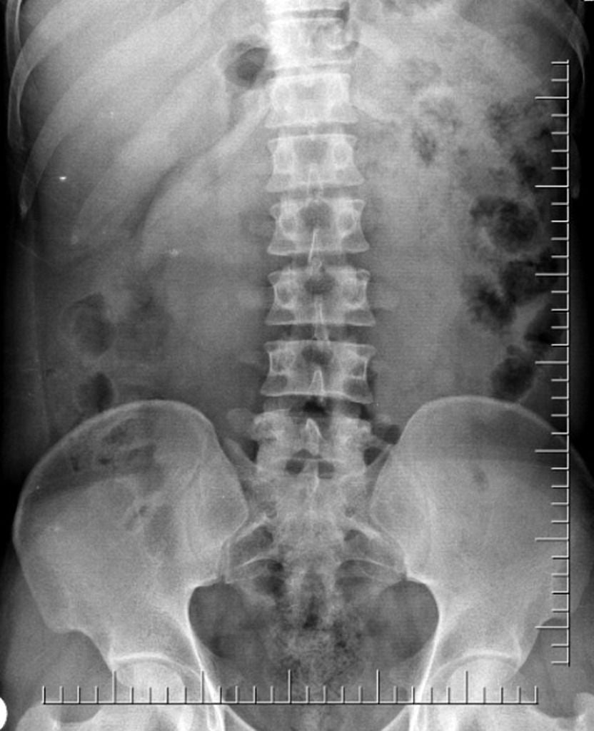 Normal Kidney X Ray Images