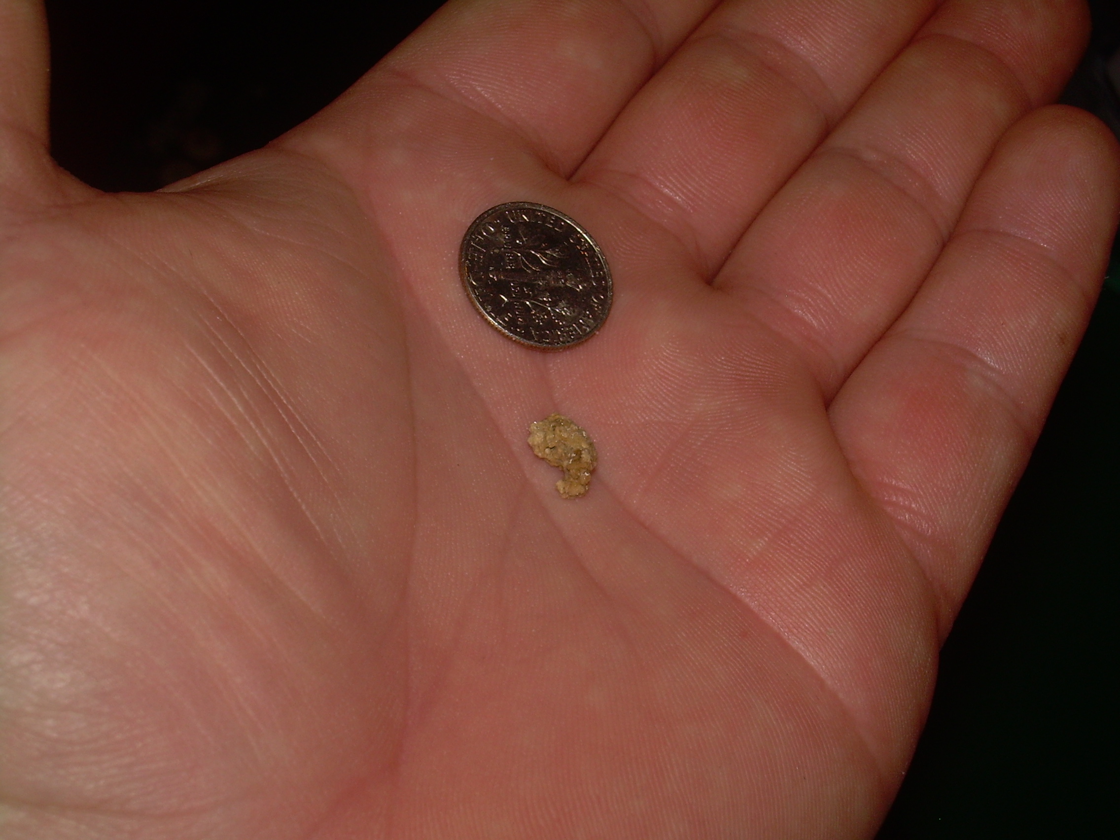 One HUGE kidney stone! 11mm x 7mm x 5mm and I passed it ...