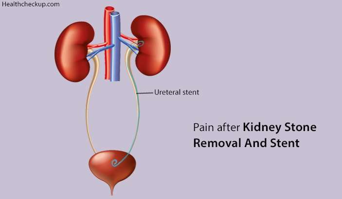 Pain after Kidney Stone Removal and Stent â Causes ...
