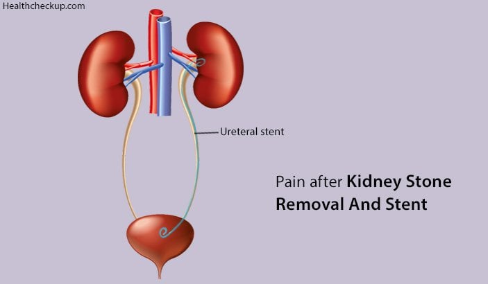 Pain after Kidney Stone Removal and Stent  Causes ...