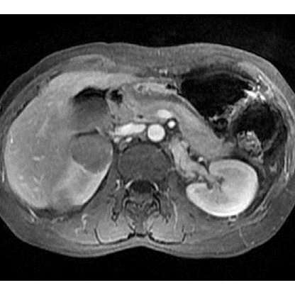 (PDF) Multiple Hypovascular Tumors in Kidney: A Rare Case ...