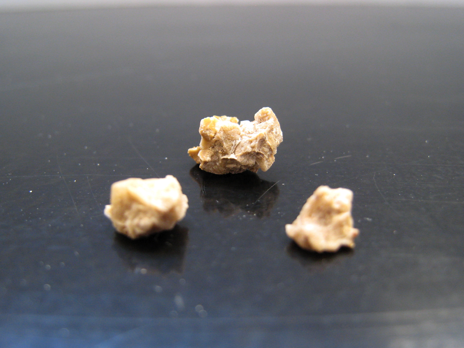 Pictures of different types of kidney stones ...