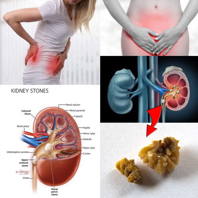 Pin on Kidney stones remedy