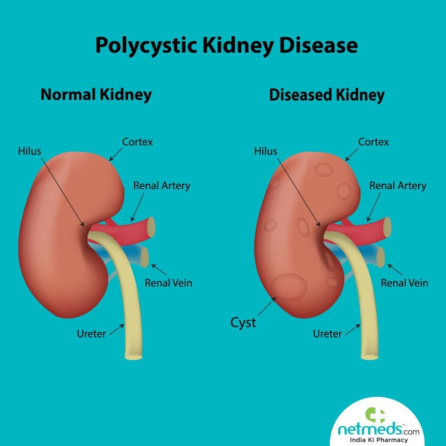 Polycystic kidney disease: Causes, Symptoms And Treatment