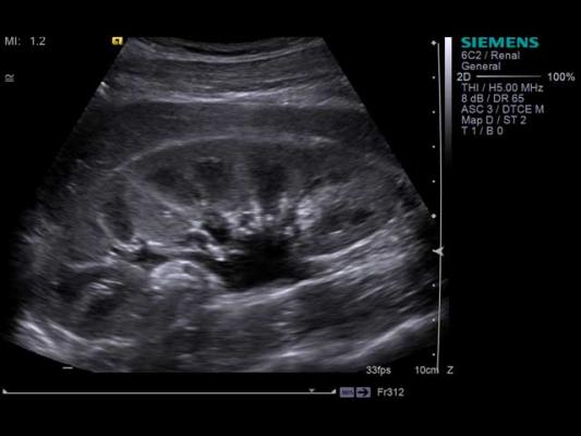Portable Ultrasound Could Improve Kidney Disease Care for ...