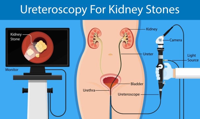 Proliferating problem of kidney stones in India
