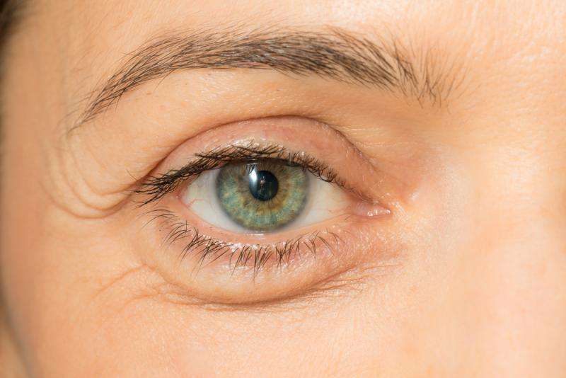 Puffiness Around Eyes Kidney Disease