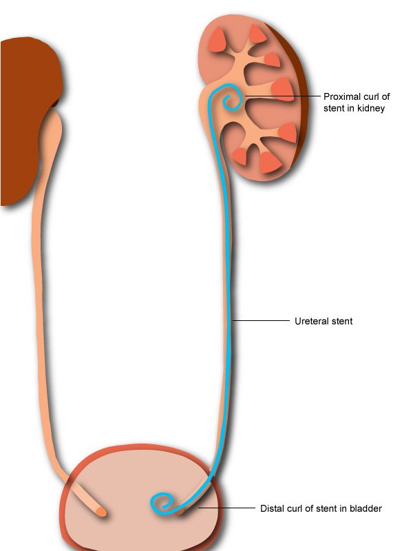 Removing your stent  Urology Associates